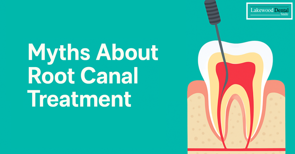 myths-about-root-canal-treatment