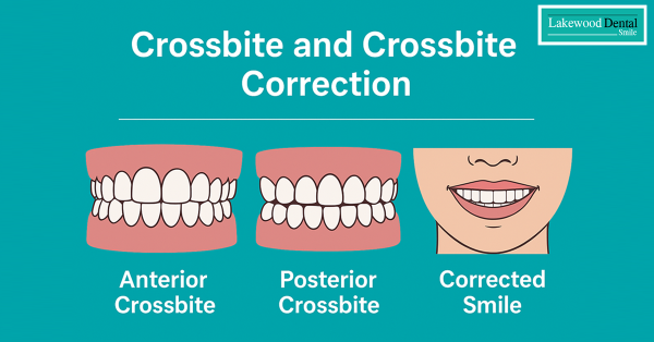 Croos-Bite-adn-Correction