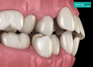 crooked teeth and misaligned bite