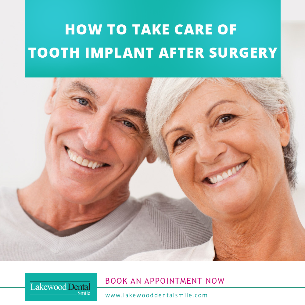 How To Take Care Of Tooth Implant After Surgery