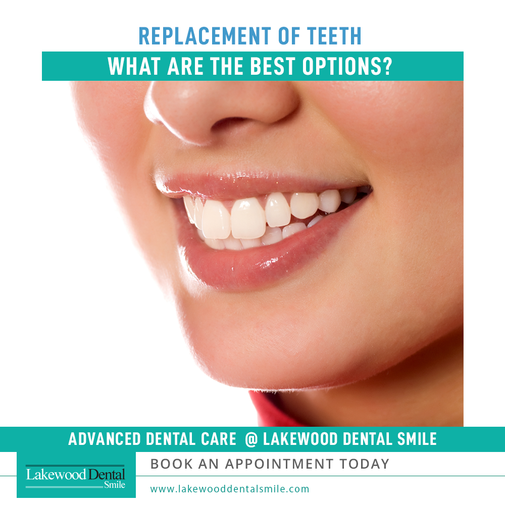 Replacement of teeth: What are the best options?